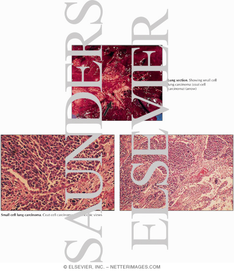 Small-Cell Lung Cancer