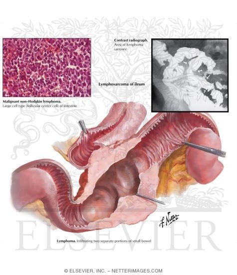 Small Intestine Cancer