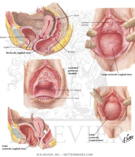 Pictures Of Cystocele