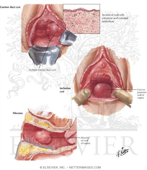 Cysts and Primary Benign and Malignant Tumors