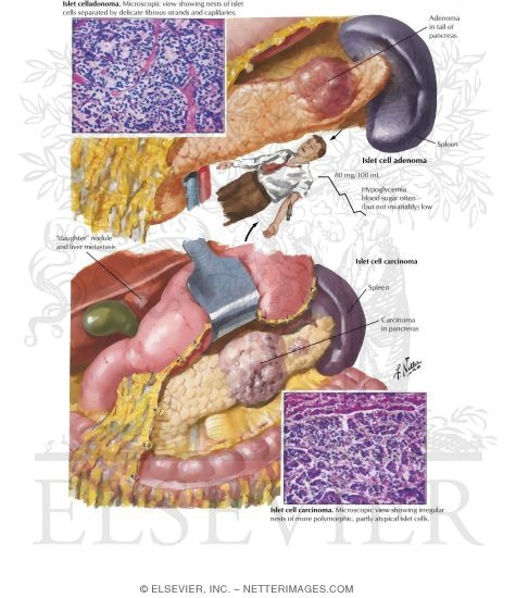 Hyperinsulinism