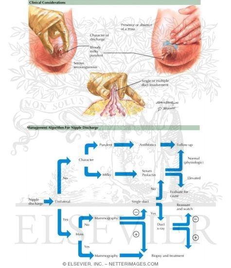 Breast: Nipple Discharge