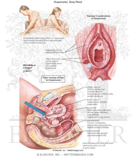 Dyspareunia: Deep Thrust