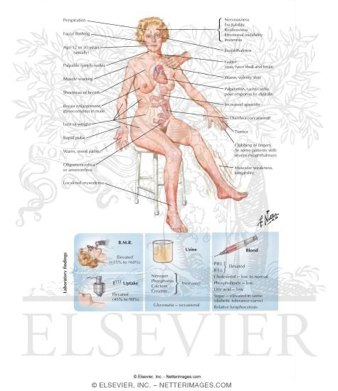 Signs and Symptoms of Graves' Disease