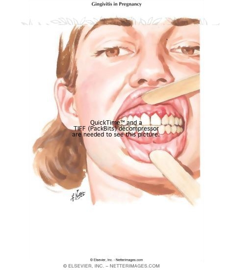 Gingivitis In Pregnancy