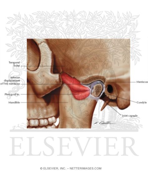 Detecting Anterior Disc Displacement of the Temporomandibular Joint