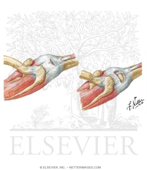 Detecting Rotator Cuff Tears: Historical Examination