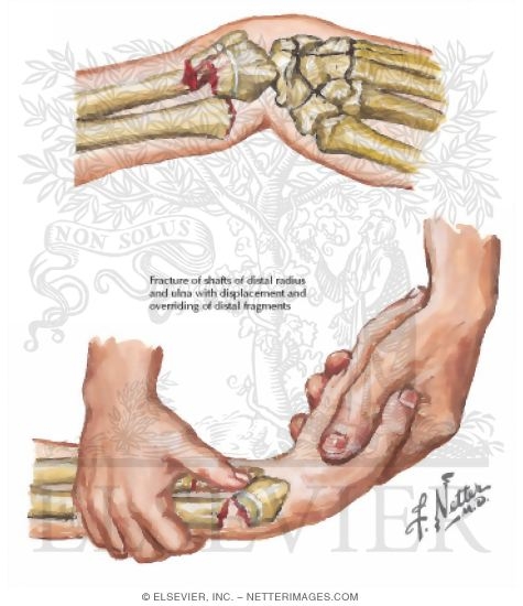 Fracture of Forearm Bones in Children