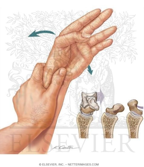 carpal instability