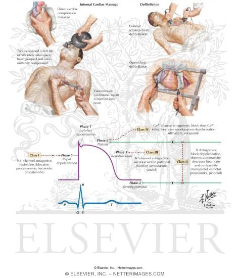 Heart Arrhythmia
