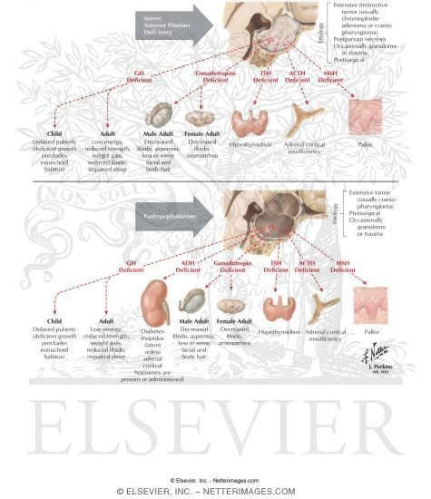 Effects of Severe Anterior Pituitary Deficiency and Panhypopituitarism