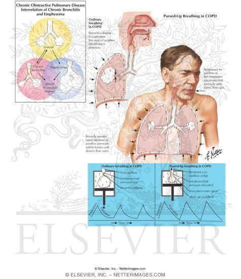 Chronic Obstructive Pulmonary Disease