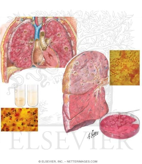 Bacterial Pneumonia