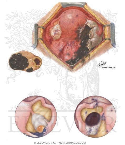Endometriosis