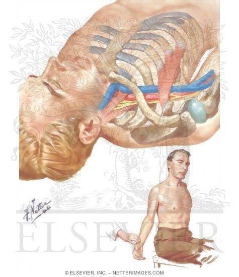 Neurovascular Syndromes of the Shoulder Girdle