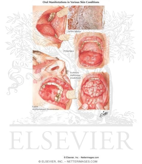 Bullous (Blister) Skin Diseases