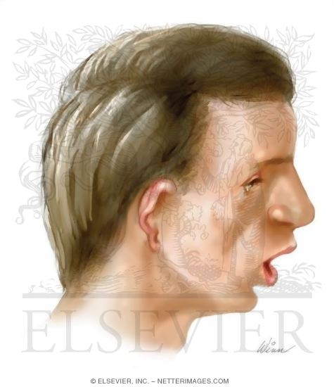 Pharyngeal Arch Abnormalities: Treacher Collins