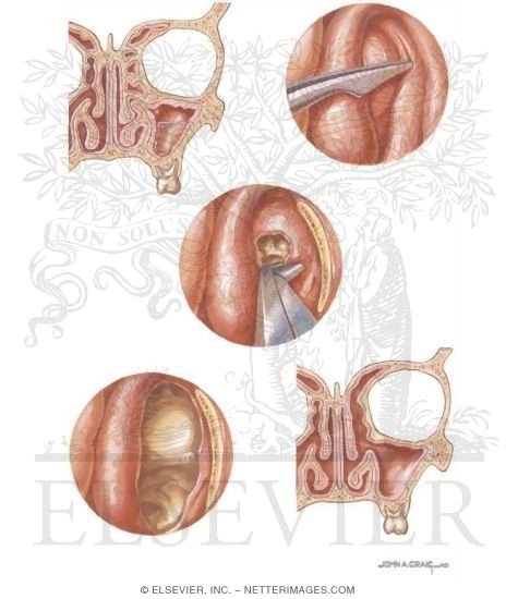 Functional Endoscopic Surgery