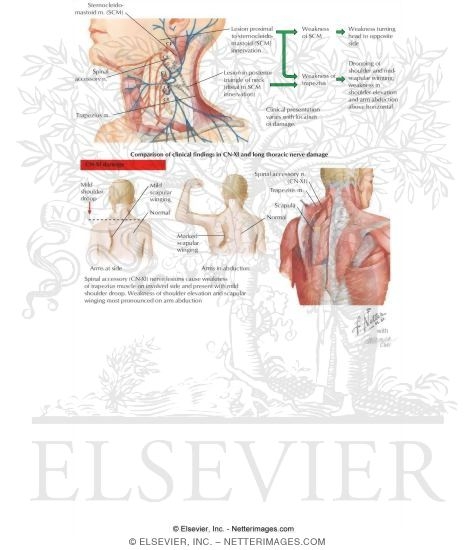 Lesions Affecting the Spinal Accessory Nerve