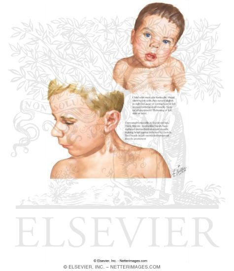 Torticollis