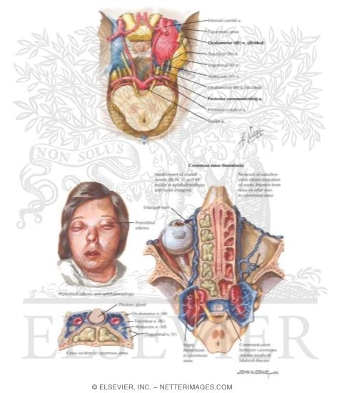 Cavernous Sinus Syndrome
