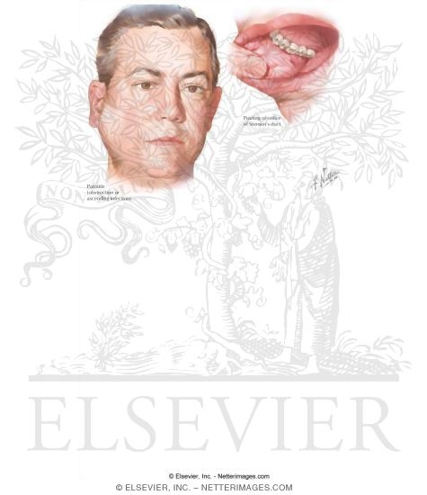 Parotitis and Mumps