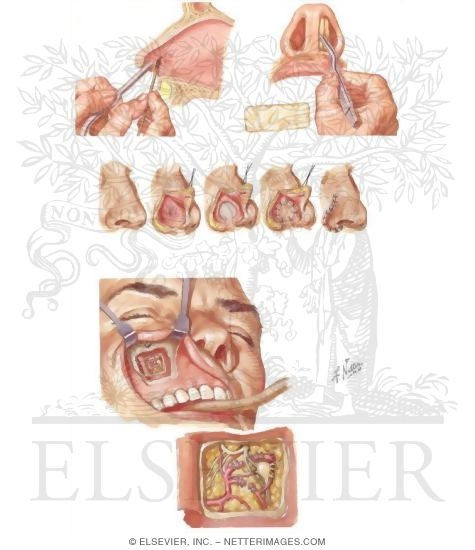 EPISTAXIS - Netter Medical Illustrations
