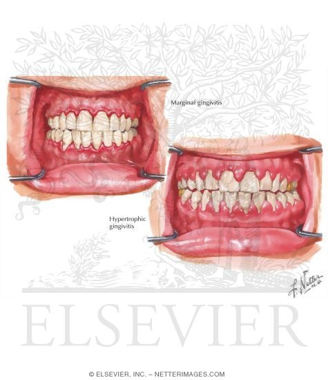Gingivitis