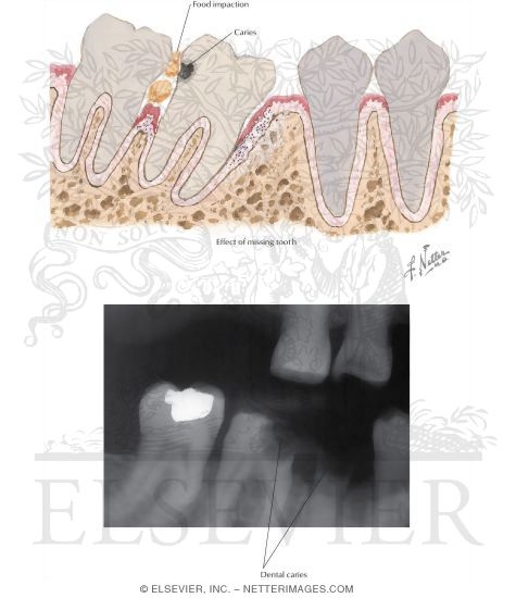 Dental Caries