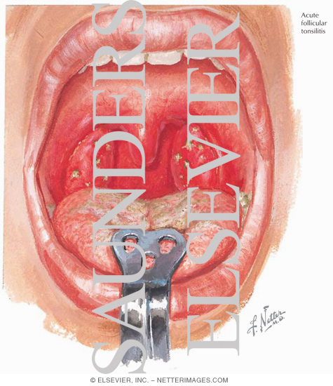 Tonsillitis