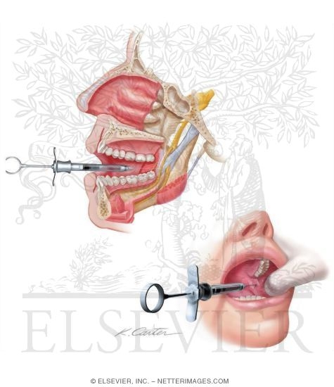 Mandibular Injections: Inferior Alveolar Nerve Block