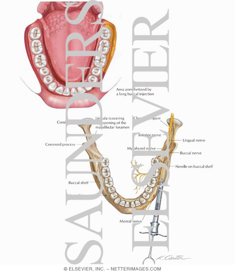 Long Buccal Nerve Block