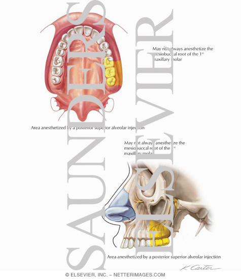 Maxillary Injections: Posterior Superior Alveolar Nerve Block