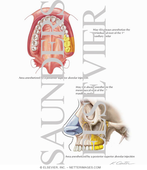 Maxillary Injections: Posterior Superior Alveolar Nerve Block