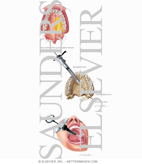 Maxillary Injections: Greater Palatine Nerve Block