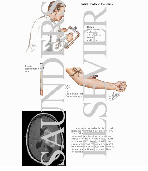 Initial Headache Evaluation