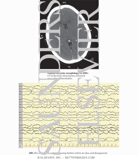 Hypoxic-Ischemic Encephalopathy