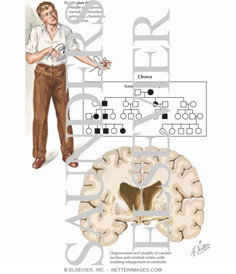 Huntington's Disease - Netter Medical Images