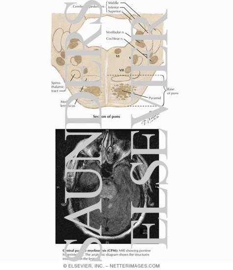 Central Pontine Myelinolysis
