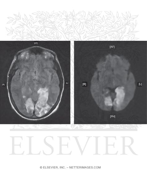 Diagnostic Tests for Infarction