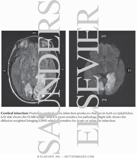 Diagnostic Tests for Infarction