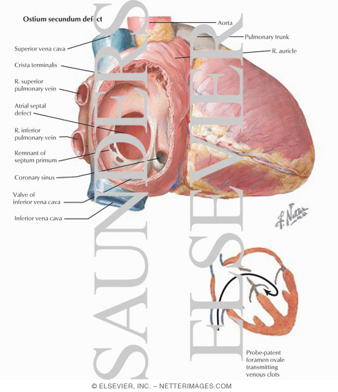 Congenital Heart Defects The preview images do not contain enough pixels to 