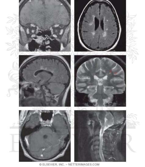 Multiple Sclerosis