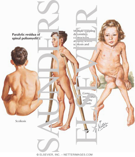 Polio and Post-polio Syndrome