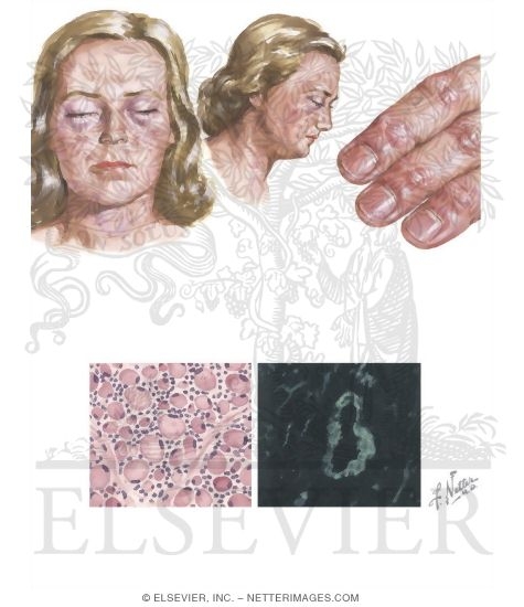 Dermatomyositis and Polymyositis