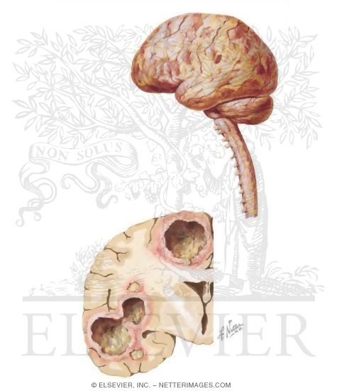 Overview of Infections