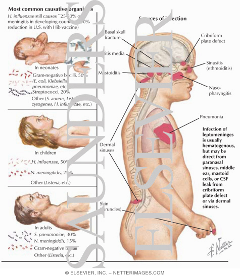 Bacterial Meningitis The preview images do not contain enough pixels to make 