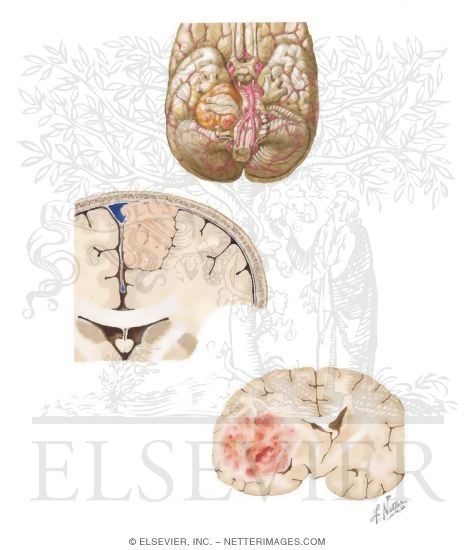 Primary Brain Tumors