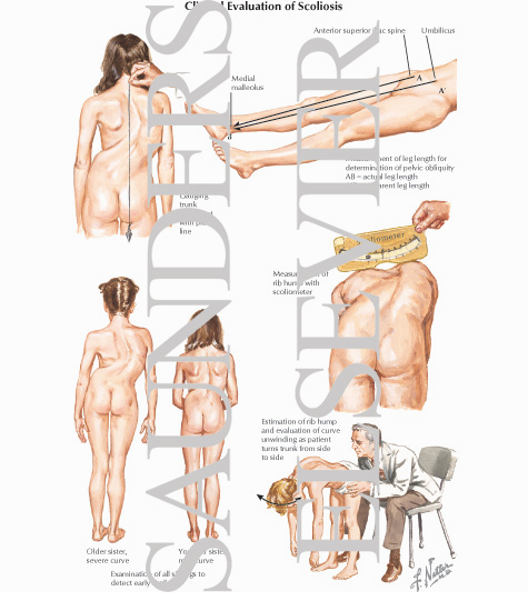 Clinical Evaluation of Scoliosis