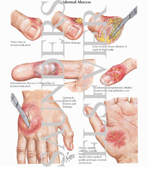 Cellulitis and Epidermal Abscess